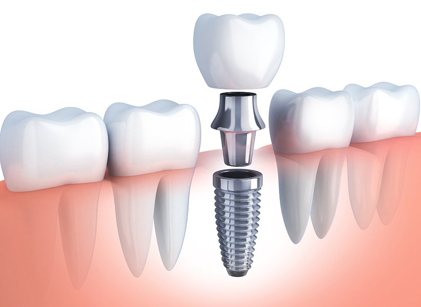 Les implants dentaires en Turquie : coût, meilleurs docteurs et chirurgiens, et satisfaction des patients internationaux