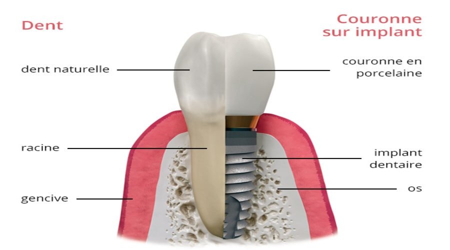 Schéma d'un implant dentaire