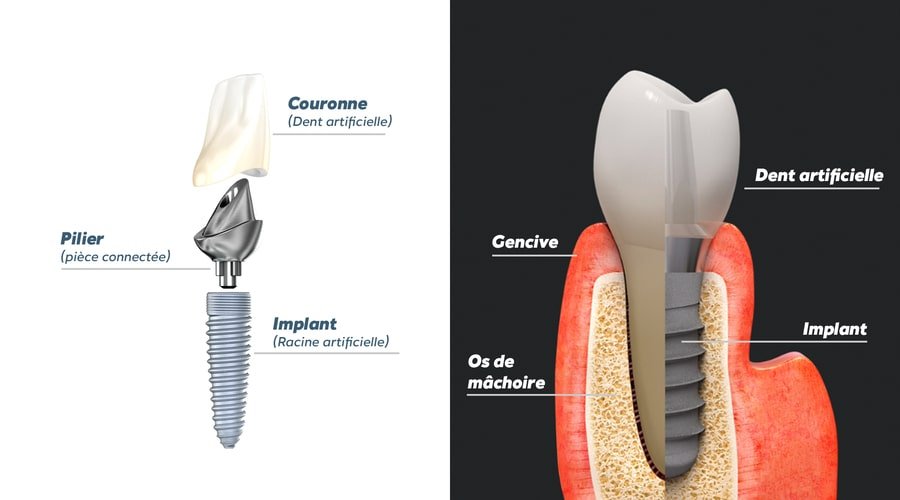 implant-dentaire