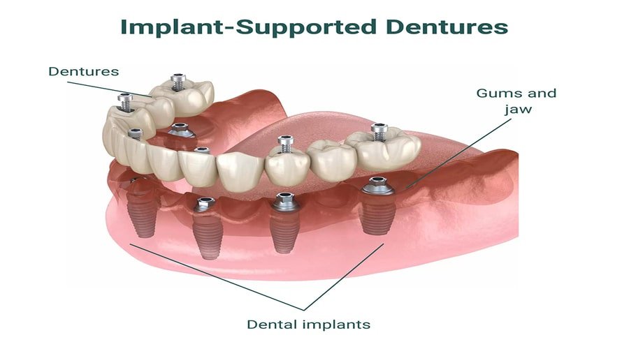 implant-supported-dentures-min