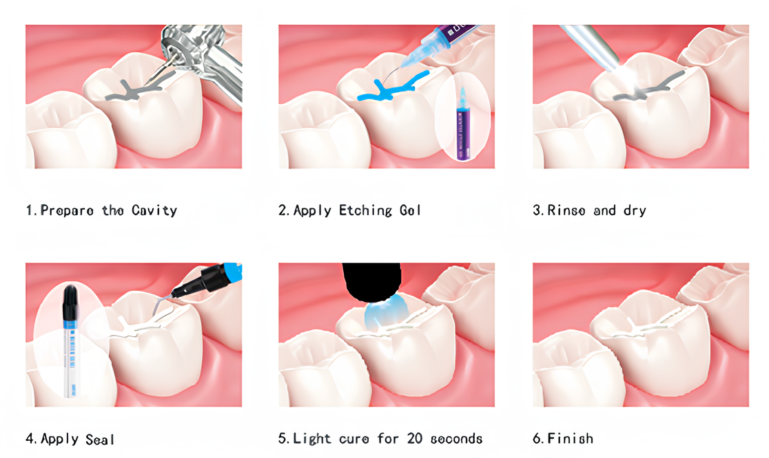 How Is Fissure Sealant Applied