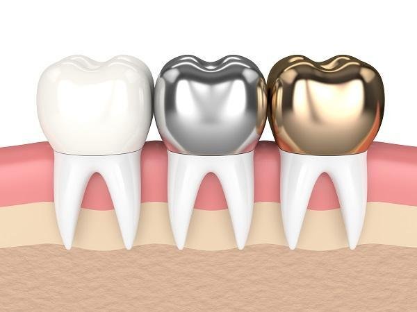 ceramic dental veneers