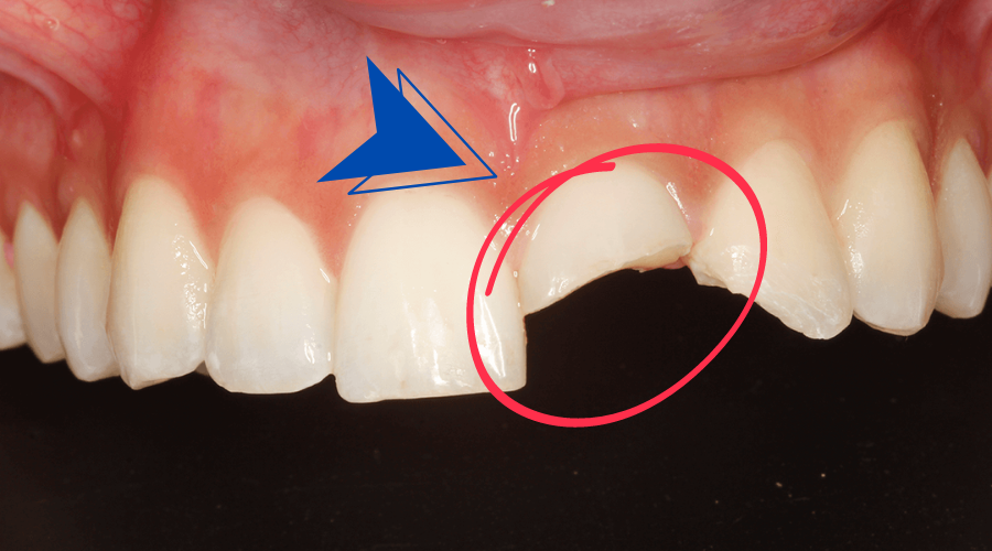 ceramic dental veneers